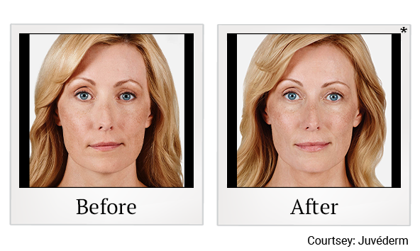 Before and After Photo 7 of Juvéderm® treatment at SF Bay Cosmetic Surgery Medical Group in San Ramon