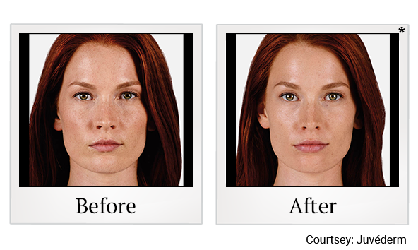 Before and After Photo 8 of Juvéderm® treatment at SF Bay Cosmetic Surgery Medical Group in San Ramon