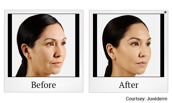 Before and After Photo 9 of Juvéderm® treatment at SF Bay Cosmetic Surgery Medical Group in San Ramon