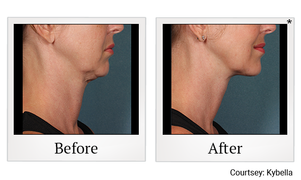 Before and After Photo 1 of Kybella® treatment at SF Bay Cosmetic Surgery Medical Group in San Ramon, Pleasanton, San Jose, and Oakland