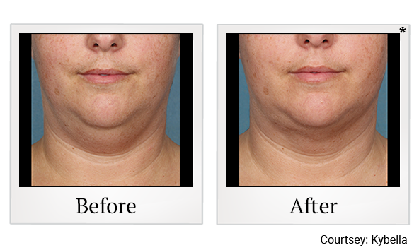 Before and After Photo 2 of Kybella® treatment at SF Bay Cosmetic Surgery Medical Group in San Ramon, Pleasanton, San Jose, and Oakland