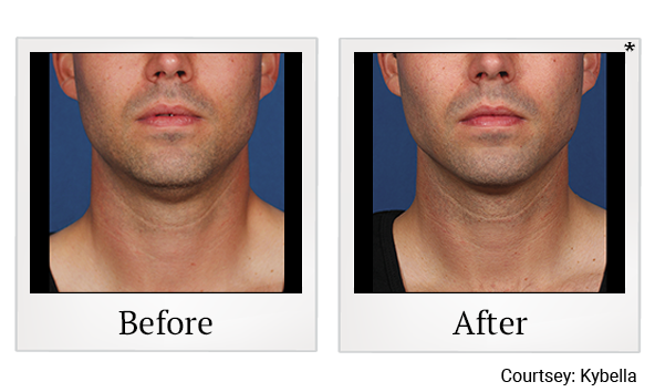 Before and After Photo 4 of Kybella® treatment at SF Bay Cosmetic Surgery Medical Group in San Ramon, Pleasanton, San Jose, and Oakland