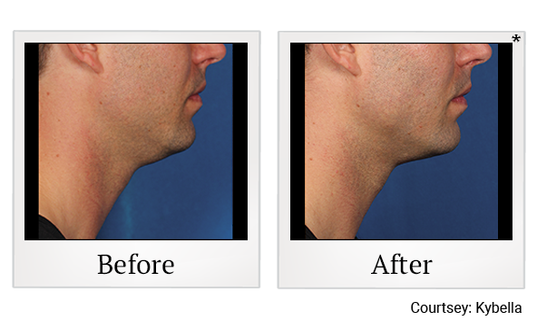 Before and After Photo 5 of Kybella® treatment at SF Bay Cosmetic Surgery Medical Group in San Ramon, Pleasanton, San Jose, and Oakland