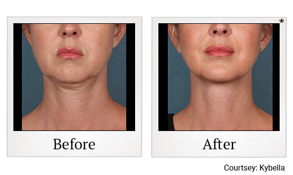 Before and After Photo 6 of Kybella® treatment at SF Bay Cosmetic Surgery Medical Group in San Ramon