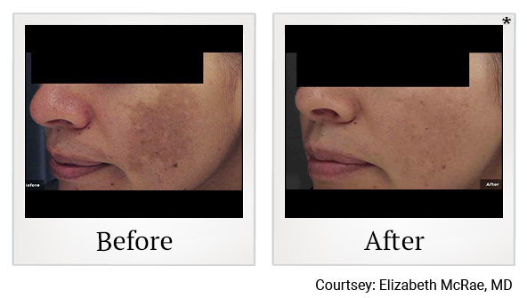 Before and After Photo 1 of LaserGenesis® treatment at SF Bay Cosmetic Surgery Medical Group in San Ramon