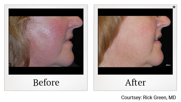 Before and After Photo 2 of LaserGenesis® treatment at SF Bay Cosmetic Surgery Medical Group in San Ramon