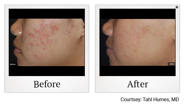 Before and After Photo 3 of LaserGenesis® treatment at SF Bay Cosmetic Surgery Medical Group in San Ramon