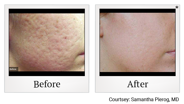 Before and After Photo 4 of LaserGenesis® treatment at SF Bay Cosmetic Surgery Medical Group in San Ramon