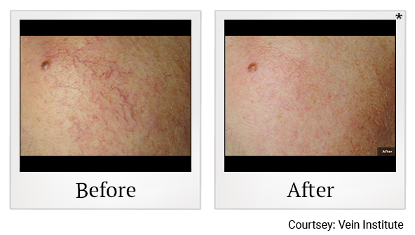 Before and After Photo 5 of LaserGenesis® treatment at SF Bay Cosmetic Surgery Medical Group in San Ramon