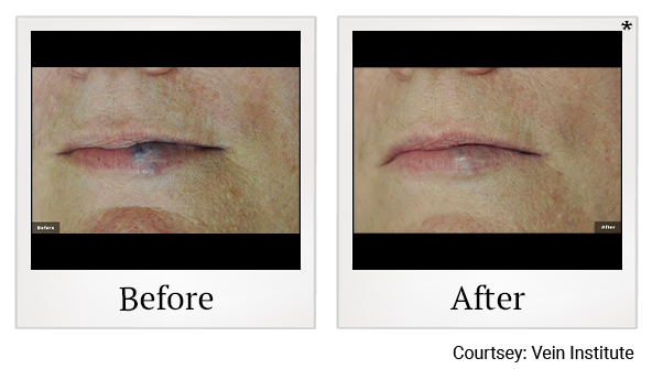 Before and After Photo 6 of LaserGenesis® treatment at SF Bay Cosmetic Surgery Medical Group in San Ramon