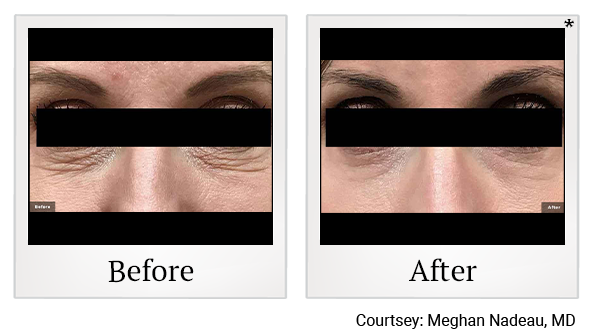 Before and After Photo 7 of LaserGenesis® treatment at SF Bay Cosmetic Surgery Medical Group in San Ramon