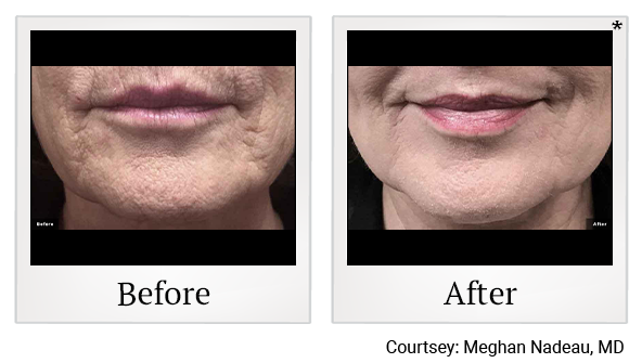 Before and After Photo 8 of LaserGenesis® treatment at SF Bay Cosmetic Surgery Medical Group in San Ramon