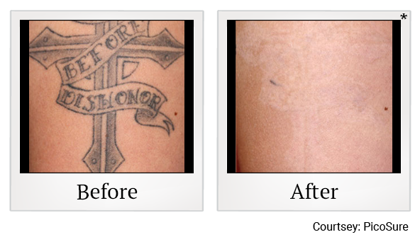 Before and After Photo 1 of Laser Tattoo Removal treatment at SF Bay Cosmetic Surgery Medical Group in San Ramon