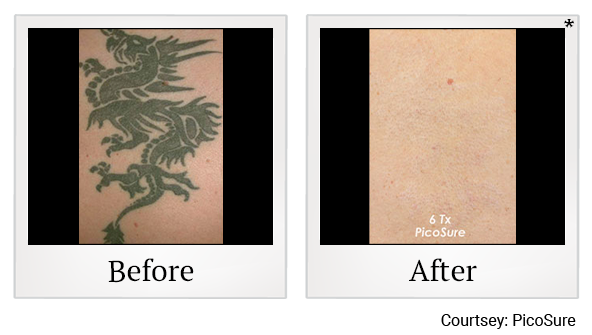 Before and After Photo 2 of Laser Tattoo Removal treatment at SF Bay Cosmetic Surgery Medical Group in San Ramon
