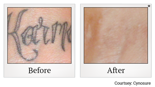 Before and After Photo 3 of Laser Tattoo Removal treatment at SF Bay Cosmetic Surgery Medical Group in San Ramon