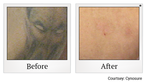Before and After Photo 4 of Laser Tattoo Removal treatment at SF Bay Cosmetic Surgery Medical Group in San Ramon