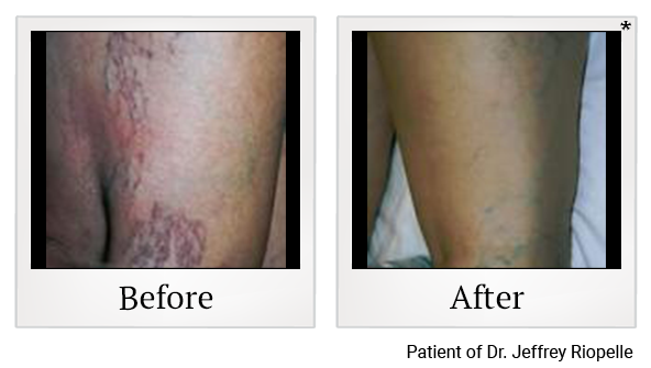 Before and After Photo 2 of Laser Vein Therapy treatment at SF Bay Cosmetic Surgery Medical Group in San Ramon