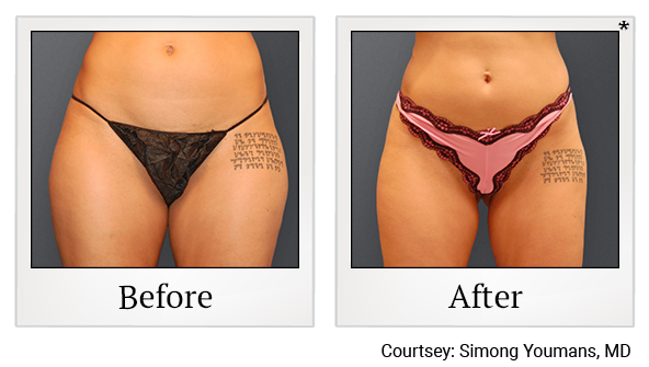 Before and After Photo 10 of Smartlipo® & Lipo treatment at SF Bay Cosmetic Surgery Medical Group in San Ramon