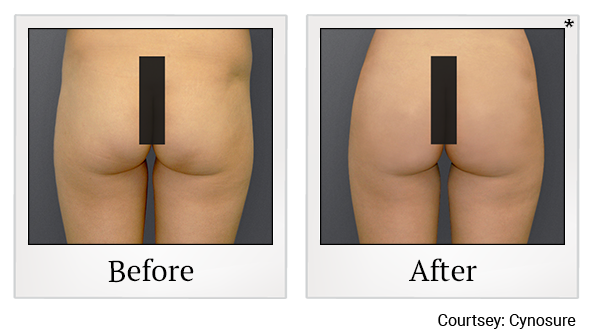 Before and After Photo 11 of Smartlipo® & Lipo treatment at SF Bay Cosmetic Surgery Medical Group in San Ramon