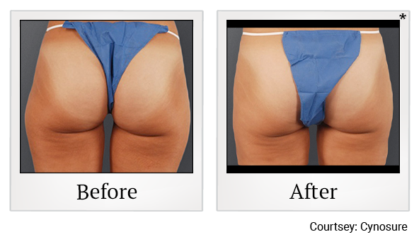 Before and After Photo 12 of Smartlipo® & Lipo treatment at SF Bay Cosmetic Surgery Medical Group in San Ramon