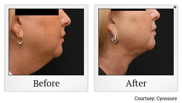 Before and After Photo 17 of Smartlipo® & Lipo treatment at SF Bay Cosmetic Surgery Medical Group in San Ramon