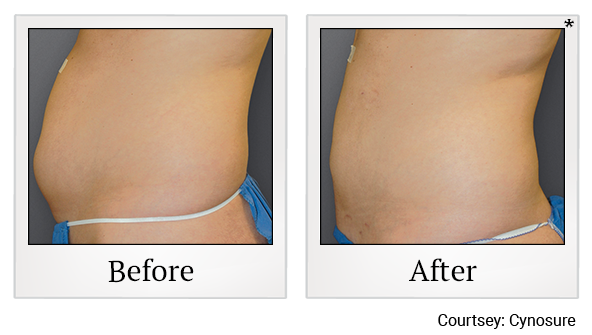 Before and After Photo 3 of Smartlipo® & Lipo treatment at SF Bay Cosmetic Surgery Medical Group in San Ramon