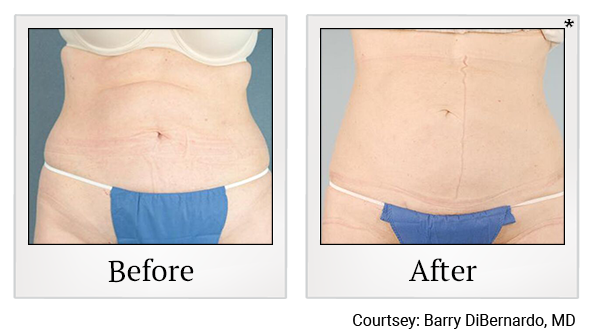 Before and After Photo 6 of Smartlipo® & Lipo treatment at SF Bay Cosmetic Surgery Medical Group in San Ramon