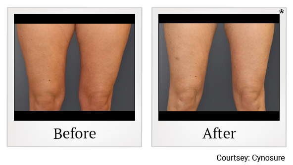 Before and After Photo 9 of Smartlipo® & Lipo treatment at SF Bay Cosmetic Surgery Medical Group in San Ramon