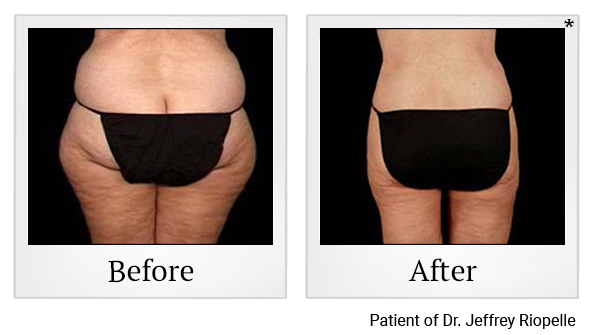 Before and After Photo 1 of Smartlipo® & Lipo treatment at SF Bay Cosmetic Surgery Medical Group in San Ramon