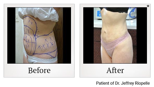 Before and After Photo 10 of Smartlipo® & Lipo treatment at SF Bay Cosmetic Surgery Medical Group in San Ramon