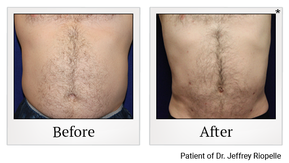 Before and After Photo 14 of Smartlipo® & Lipo treatment at SF Bay Cosmetic Surgery Medical Group in San Ramon