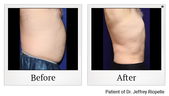 Before and After Photo 5 of Smartlipo® & Lipo treatment at SF Bay Cosmetic Surgery Medical Group in San Ramon