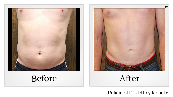 Before and After Photo 18 of Smartlipo® & Lipo treatment at SF Bay Cosmetic Surgery Medical Group in San Ramon