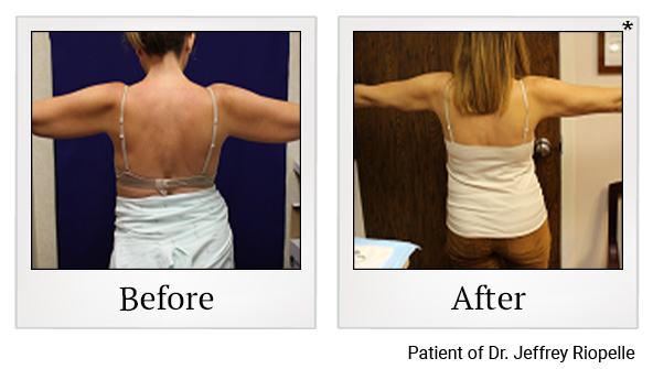 Before and After Photo 19 of Smartlipo® & Lipo treatment at SF Bay Cosmetic Surgery Medical Group in San Ramon