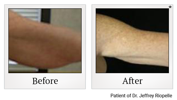 Before and After Photo 2 of Smartlipo® & Lipo treatment at SF Bay Cosmetic Surgery Medical Group in San Ramon