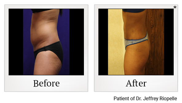 Before and After Photo 20 of Smartlipo® & Lipo treatment at SF Bay Cosmetic Surgery Medical Group in San Ramon