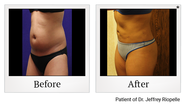 Before and After Photo 12 of Smartlipo® & Lipo treatment at SF Bay Cosmetic Surgery Medical Group in San Ramon
