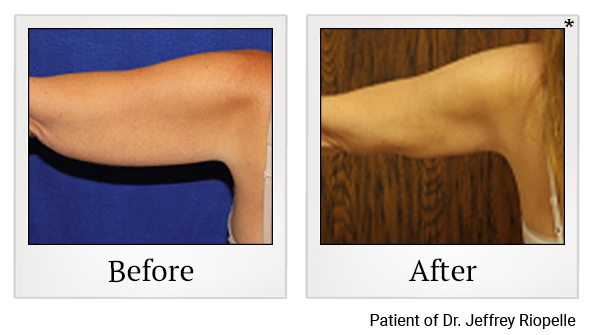 Before and After Photo 22 of Smartlipo® & Lipo treatment at SF Bay Cosmetic Surgery Medical Group in San Ramon