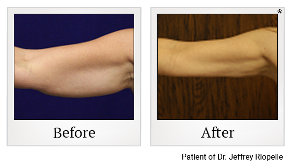 Before and After Photo 23 of Smartlipo® & Lipo treatment at SF Bay Cosmetic Surgery Medical Group in San Ramon