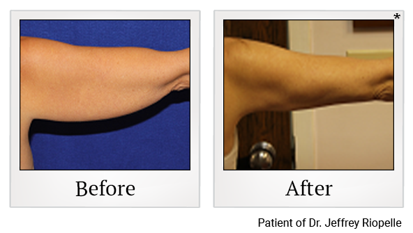 Before and After Photo 25 of Smartlipo® & Lipo treatment at SF Bay Cosmetic Surgery Medical Group in San Ramon