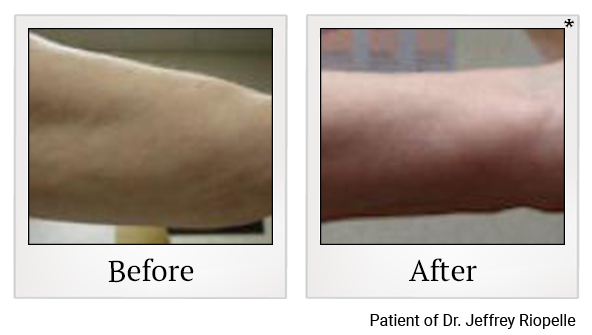 Before and After Photo 4 of Smartlipo® & Lipo treatment at SF Bay Cosmetic Surgery Medical Group in San Ramon
