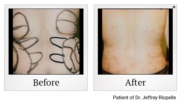 Before and After Photo 5 of Smartlipo® & Lipo treatment at SF Bay Cosmetic Surgery Medical Group in San Ramon