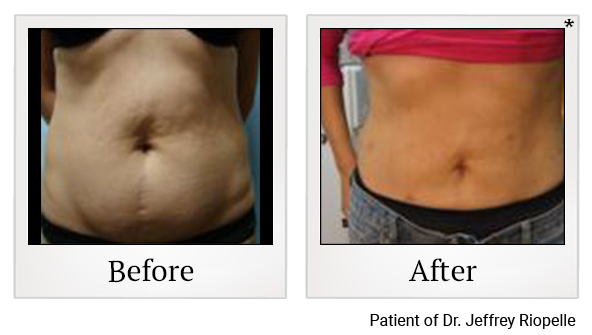 Before and After Photo 6 of Smartlipo® & Lipo treatment at SF Bay Cosmetic Surgery Medical Group in San Ramon