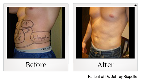 Before and After Photo 8 of Smartlipo® & Lipo treatment at SF Bay Cosmetic Surgery Medical Group in San Ramon