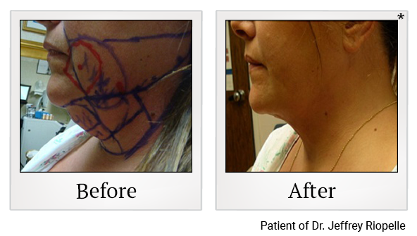 Before and After Photo 9 of Smartlipo® & Lipo treatment at SF Bay Cosmetic Surgery Medical Group in San Ramon