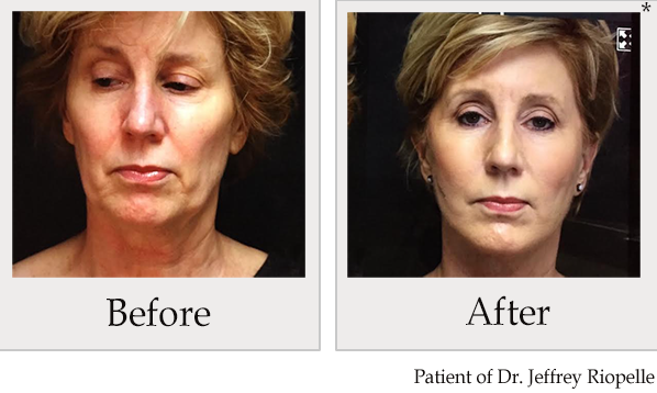Before and After Photo 1 of PDO Thread Facelift treatment at SF Bay Cosmetic Surgery Medical Group in San Ramon, Pleasanton, San Jose, and Oakland