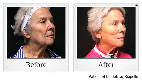 Before and After Photo 2 of PDO Thread Facelift treatment at SF Bay Cosmetic Surgery Medical Group in San Ramon, Pleasanton, San Jose, and Oakland