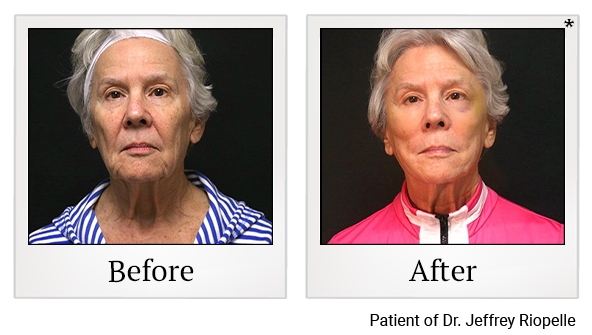 Before and After Photo 3 of PDO Thread Facelift treatment at SF Bay Cosmetic Surgery Medical Group in San Ramon