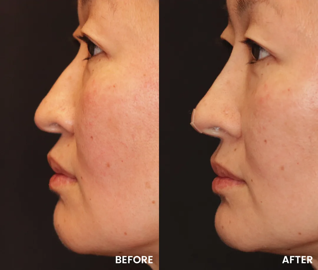 Before and After Photo 5 of PDO Thread Facelift treatment at SF Bay Cosmetic Surgery Medical Group in San Ramon, Pleasanton, San Jose, and Oakland