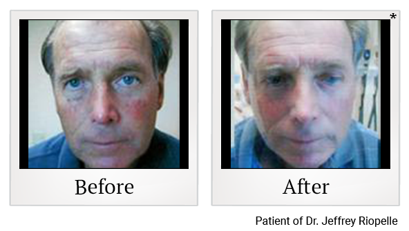 Before and After Photo 1 of Photodynamic Therapy treatment at SF Bay Cosmetic Surgery Medical Group in San Ramon
